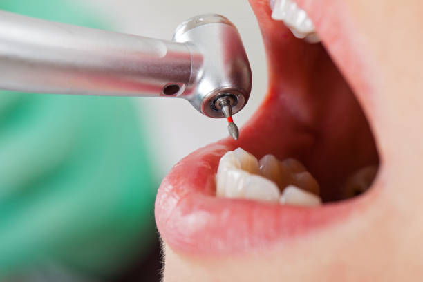 Best Emergency Wisdom Teeth Removal in Black Forest, CO